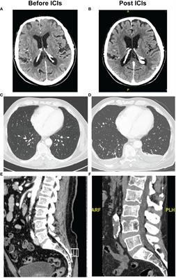 Case report: Fast disease progression during adjuvant therapy with anti-PD-1 in stage III melanoma patients